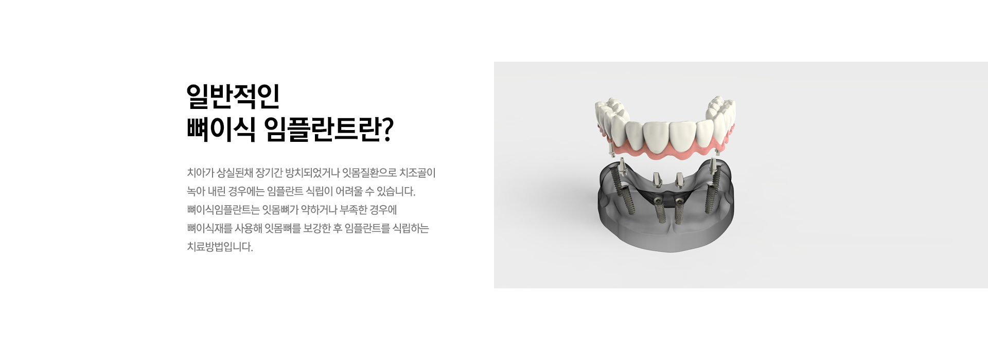 자가치아 뼈이식